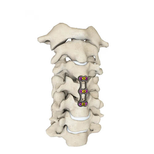 Orthopedic Implant -- Intramedllary Nailing